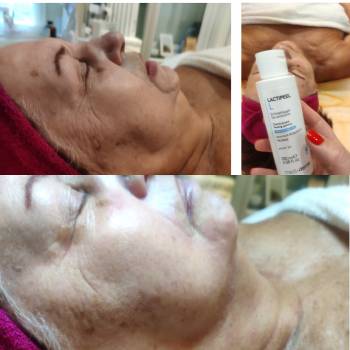 Пиллинг+ введение 3D коктейля+ маска Ботекс. 