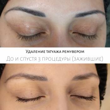 Удаление татуажа ремувером