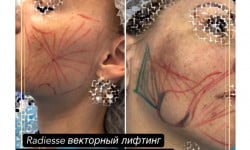 Radiesse Радиесс векторный лифтинг мезорадиесс терапия Врач-косметолог Юлия Баркова Киев