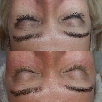 Осветляющая процедура для области глаз