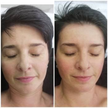 Уходовая процедура с витамином С