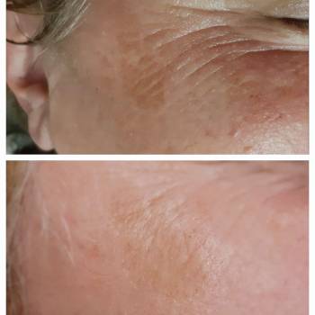 Осветление пигментных пятен