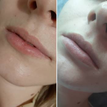 Зажившие губы после контурной пластики губ