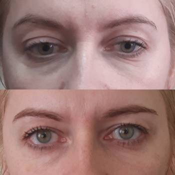 Уплотнение кожи периорбитальной кожи при помощи методики жид