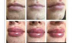 Контурная пластика губ Врач-косметолог Юлия Баркова Киев