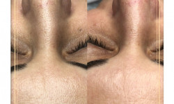 Чистка лица ультразвуковая Врач-косметолог Юлия Баркова Киев