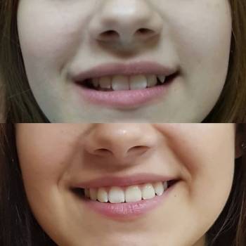 уколы ботокса для лица