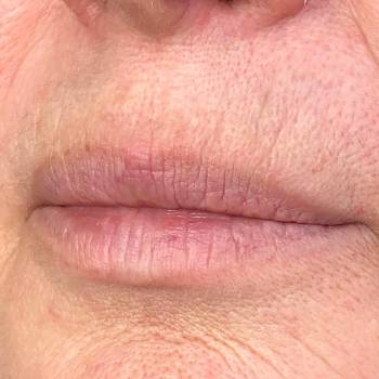 увеличение губ, уколы ботокса для лица, коррекция морщин