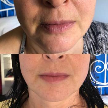 уход за лицом, коррекция морщин