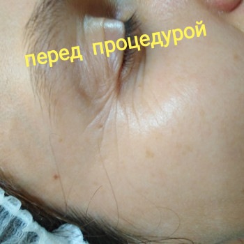 перед первой процедурой