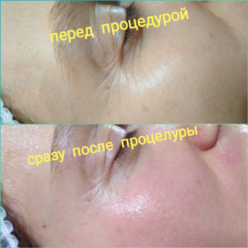 Препарат с аминопротеинами и гиалуронкой