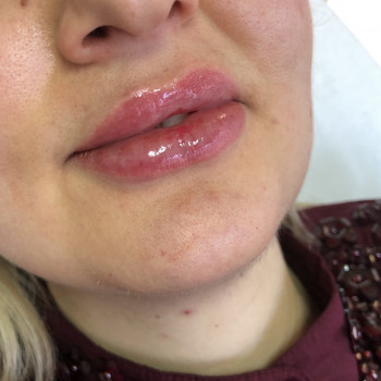 Збільшення губ
                    Лікар-косметолог Ірина Львів