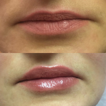 Збільшення губ
                    Лікар-косметолог Ірина Львів