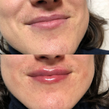 Збільшення губ
                    Лікар-косметолог Ірина Львів