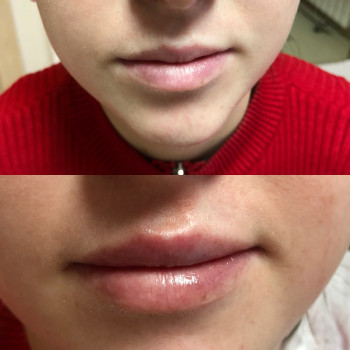 Збільшення губ
                    Лікар-косметолог Ірина Львів