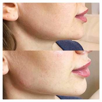 Збільшення губ уколи в обличчя, фото -  Top Face