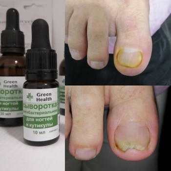 Зачистка/лечение онихолизиса
                    СПА-салон Green Health Одесса