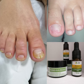 Зачистка/лечение онихолизиса
                    СПА-салон Green Health Одесса