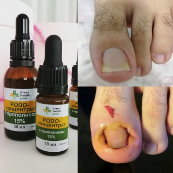 Удаление мозолей
                    СПА-салон Green Health Одеса