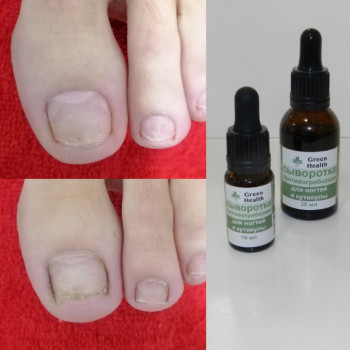 Удаление мозолей
                    СПА-салон Green Health Одеса