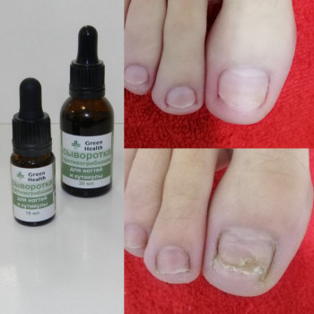 Удаление мозолей
                    СПА-салон Green Health Одеса