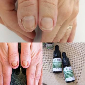 Удаление мозолей
                    СПА-салон Green Health Одеса