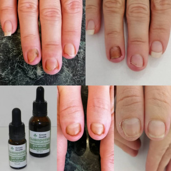 Удаление мозолей
                    СПА-салон Green Health Одеса