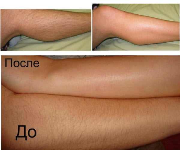 Подготовка к процедуре