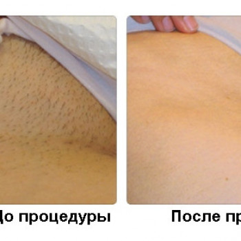 Шугаринг (женский) ягодиц
                    СПА-салон Green Health Одеса