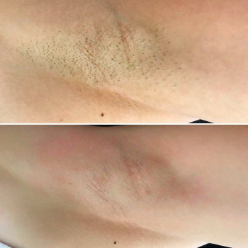 Шугаринг (женский) ягодиц
                    СПА-салон Green Health Одеса