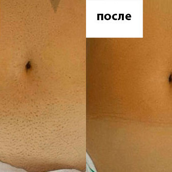 Шугаринг (женский) ягодиц
                    СПА-салон Green Health Одеса