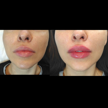 Фото з портфоліо фахівця Максим Бігун (пластичний хірург, Київ)