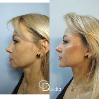 Фото з портфоліо фахівця Максим Бігун (пластичний хірург, Київ)