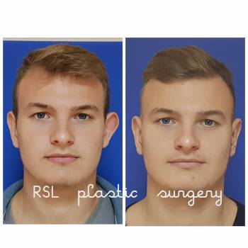 Односторонняя отопластика