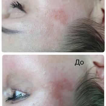 Пигментация 2 проц.