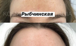 Пігментні плями Врач-косметолог Наталия Киев