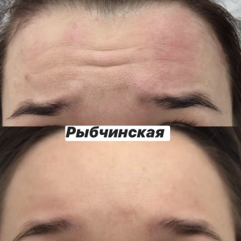 Ботулотоксин
                    Врач-косметолог Наталия Киев