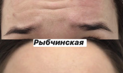 Ботулотоксин Лікар-косметолог Наталия Київ