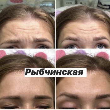 Ботулотоксин
                    Врач-косметолог Наталия Киев