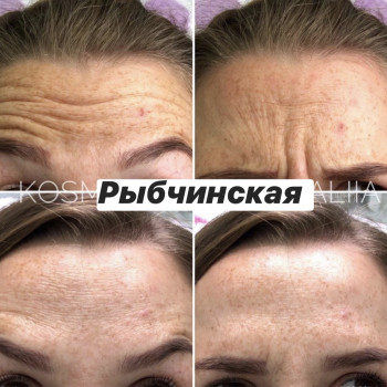 Ботулотоксин
                    Врач-косметолог Наталия Киев