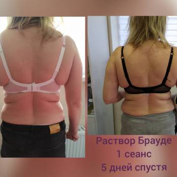 Раствор Брауде в зоне "крылышек", лопаток. 5 Дней спустя пер