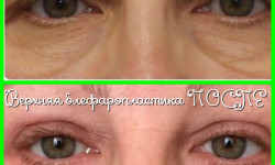 Блефаропластика верхняя и нижняя Пластичний хірург Александр Херсон