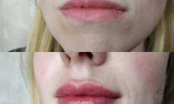 Соблазнительные губы Косметолог Екатерина Житомир