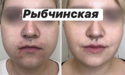 Ліполітики Чекареллі (все лицо) Лікар-косметолог Наталия Київ