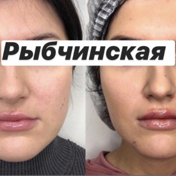 Ліполітики Чекареллі (все лицо)
                    Лікар-косметолог Наталия Київ