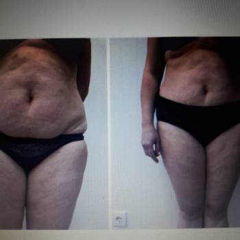 Ліполітичні коктейл( інєкції)
