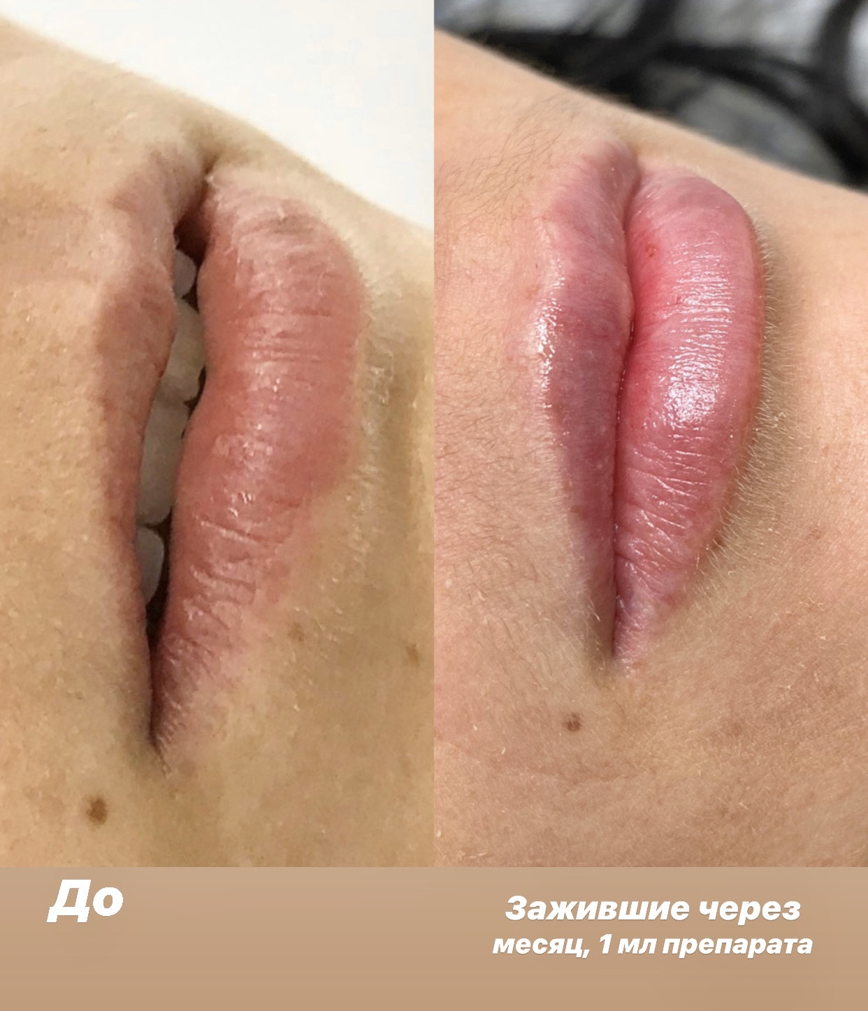 Увеличение губ контурная пластика аугментация, фото - Косметолог Анна Сломинская