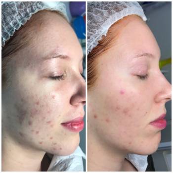 Лечение пост-акне:
подбор домашнего ухода+иньекции и пилинги