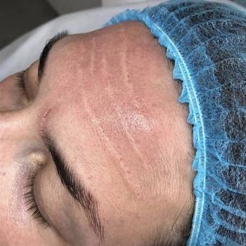 Заполнение морщин в технике бланшинг