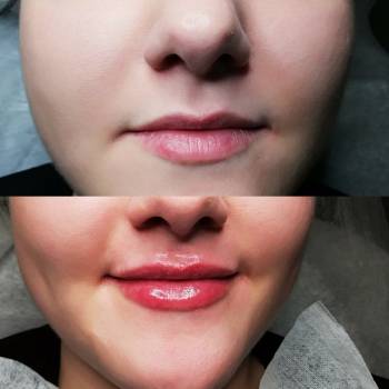 Контурная пластика губ